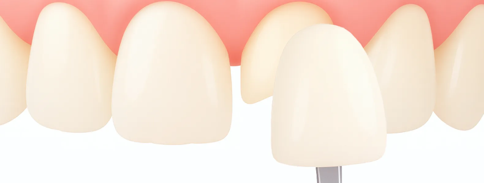 インプラント治療