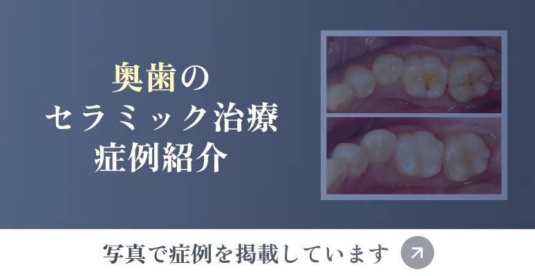 奥歯のセラミック治療症例紹介