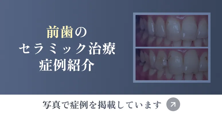 前歯のセラミック治療症例紹介