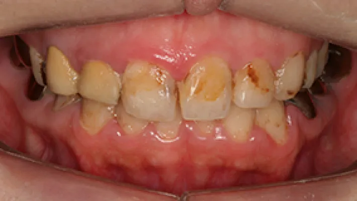 オールセラミック施術前