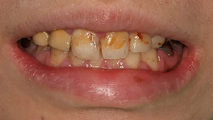 オールセラミック施術前