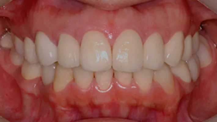 オールセラミック施術後