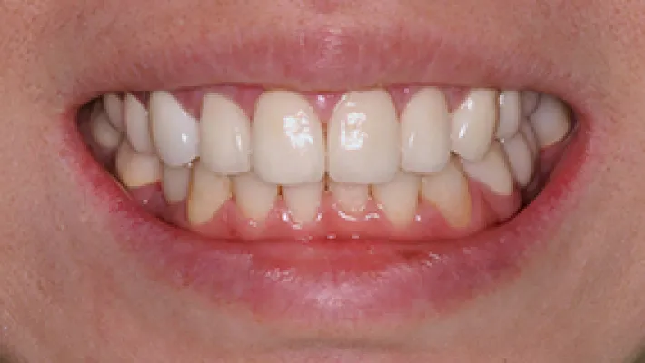 オールセラミック施術後