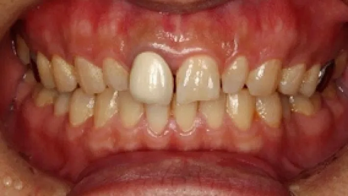 ラミネートベニア・セラミック施術前