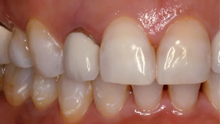 オールセラミック施術前