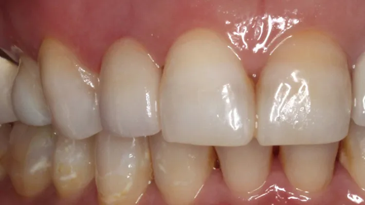 オールセラミック施術後
