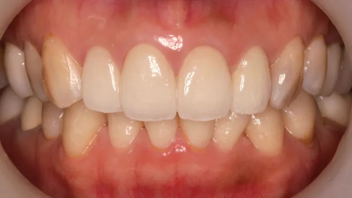 オールセラミック施術後