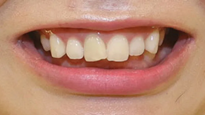 オールセラミック施術前