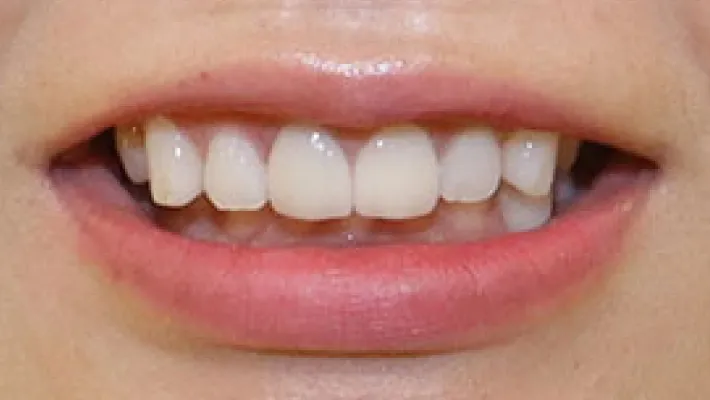 オールセラミック施術後