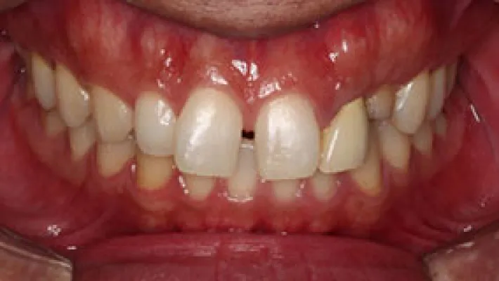 オールセラミック・ラミネートベニア施術前