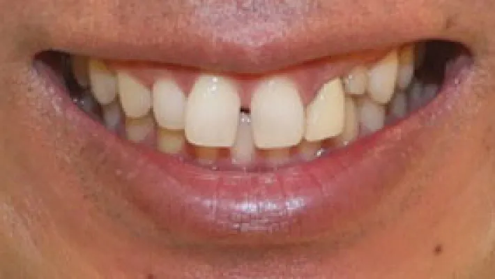 オールセラミック・ラミネートベニア施術前