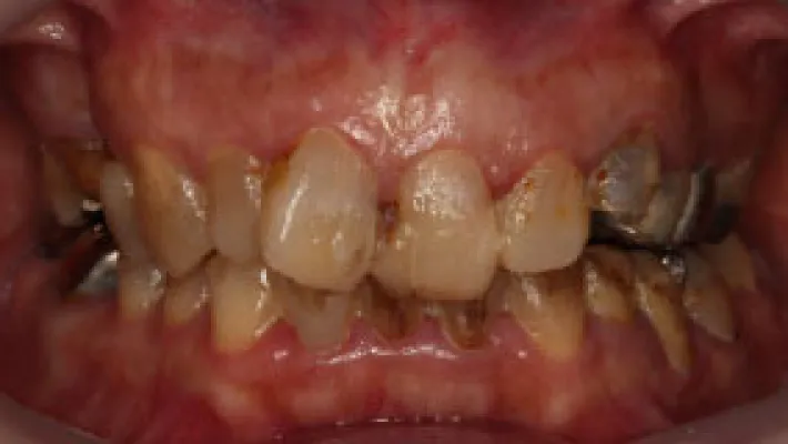 ラミネートベニア・セラミック施術前