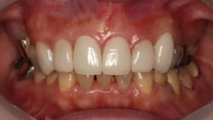 ラミネートベニア・セラミック施術後