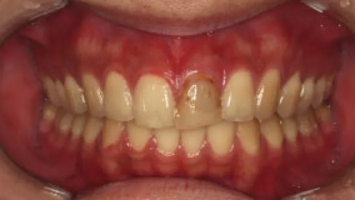 オールセラミック施術前