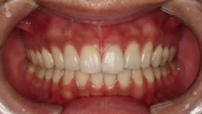 オールセラミック施術後