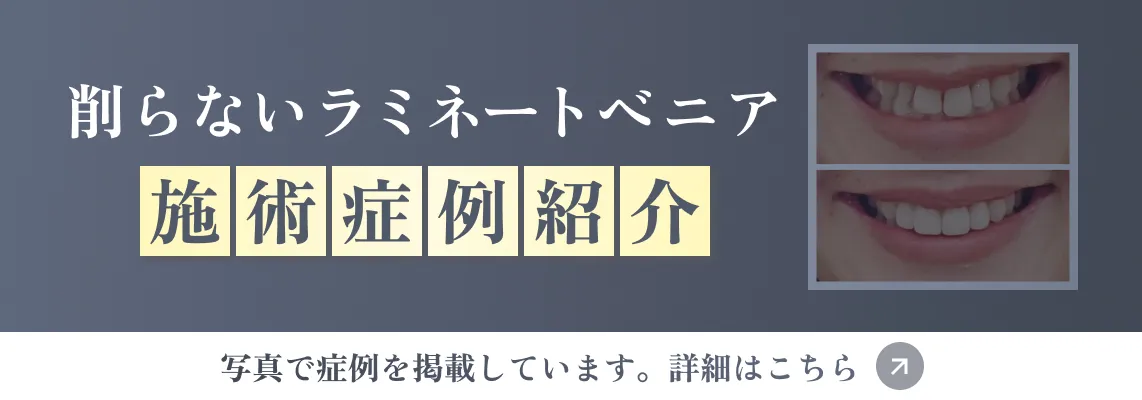 削らないラミネートべニア症例紹介