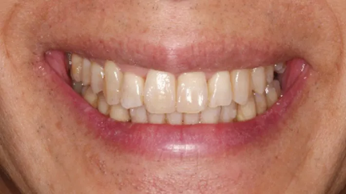 クリアコレクト矯正