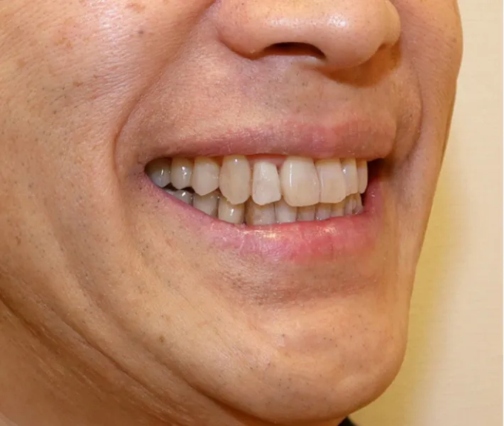 クリアコレクト矯正