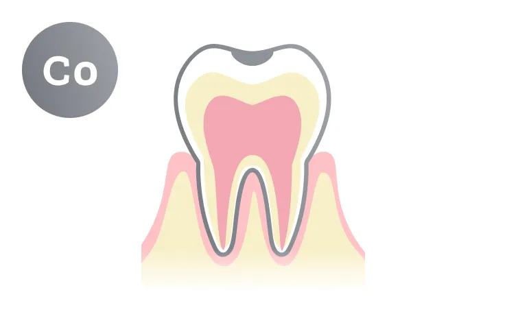 C0段階の虫歯