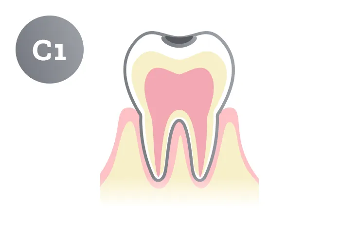 C1段階の虫歯