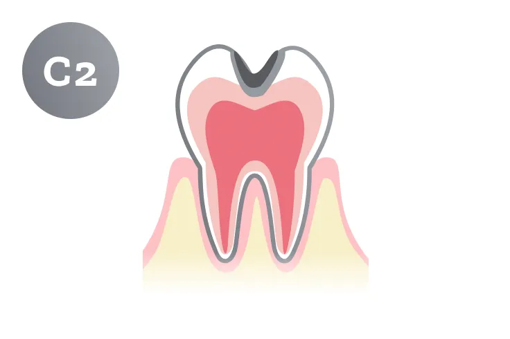 C2段階の虫歯