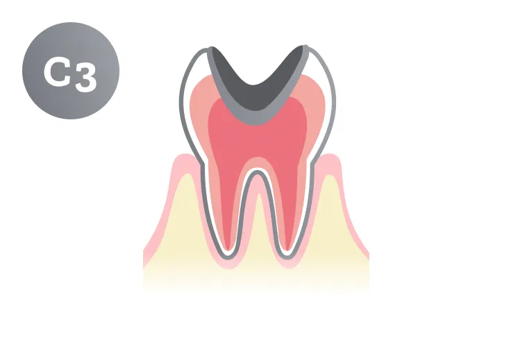 C3段階の虫歯