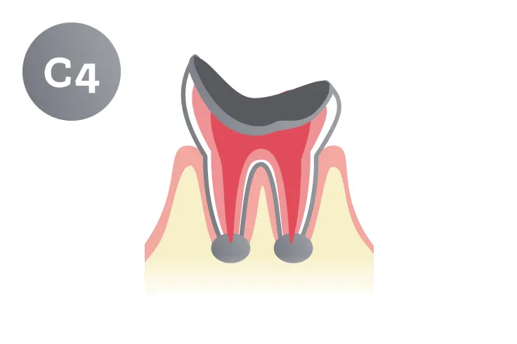 C4段階の虫歯