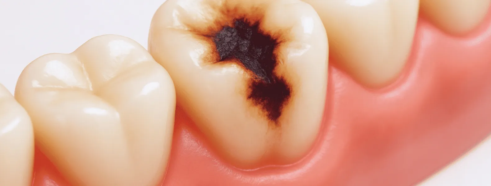 虫歯治療