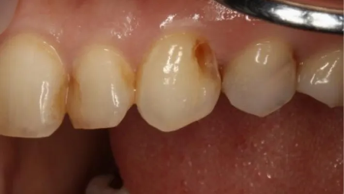 ホワイトニング後