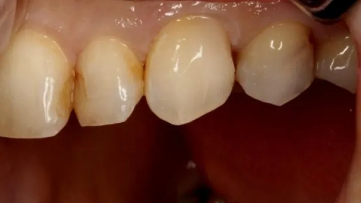 ダイレクトボンディング後