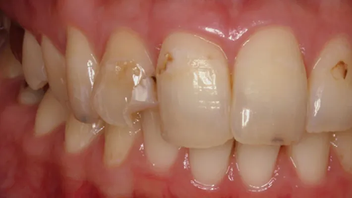 前歯セラミック矯正施術前