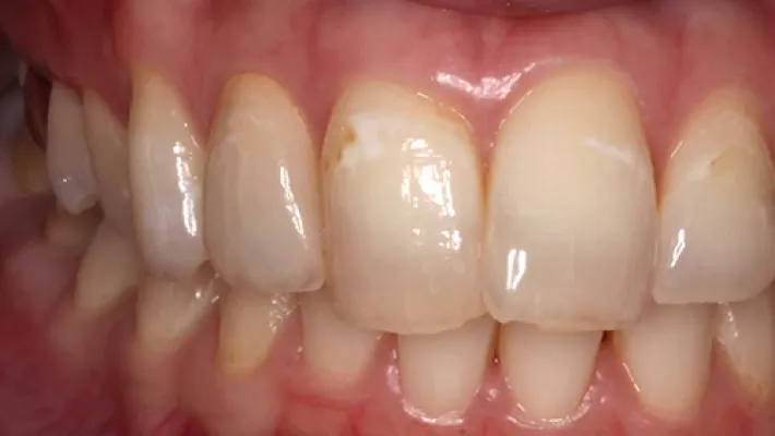 前歯セラミック矯正施術後