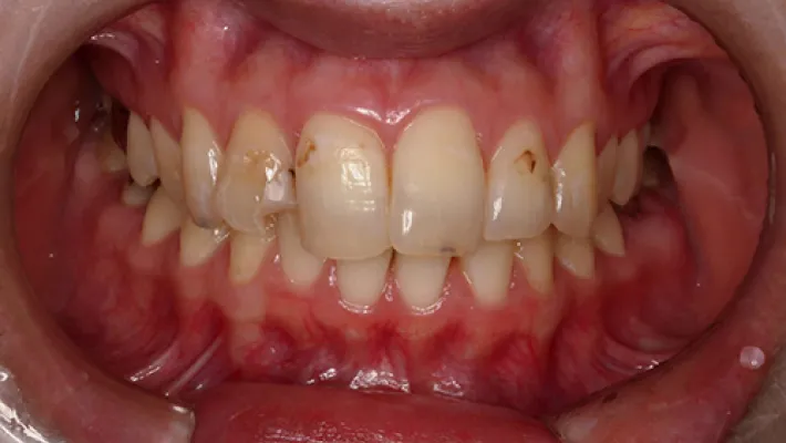 前歯セラミック矯正施術前2