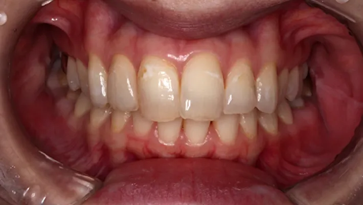 前歯セラミック矯正施術後2