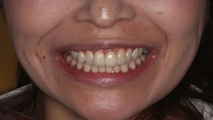 前歯セラミック矯正施術前