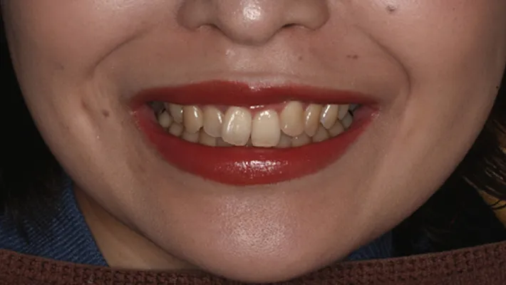 前歯セラミック矯正施術後