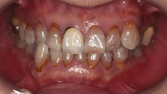 前歯ラミネートベニア修正施術前