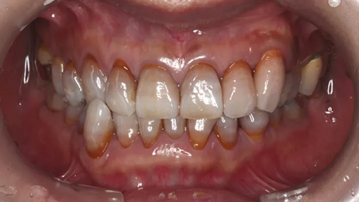 前歯ラミネートベニア修正施術後