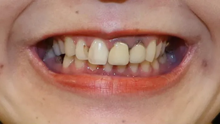 前歯セラミック矯正施術前