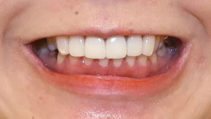 前歯セラミック矯正施術後