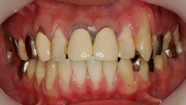 前歯ラミネートベニア修正施術前