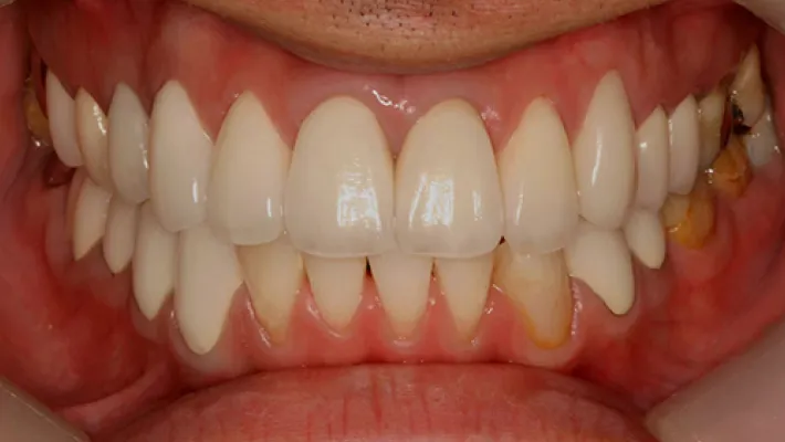 前歯ラミネートベニア修正施術後