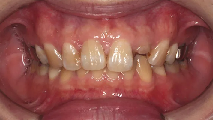 前歯セラミック矯正施術前