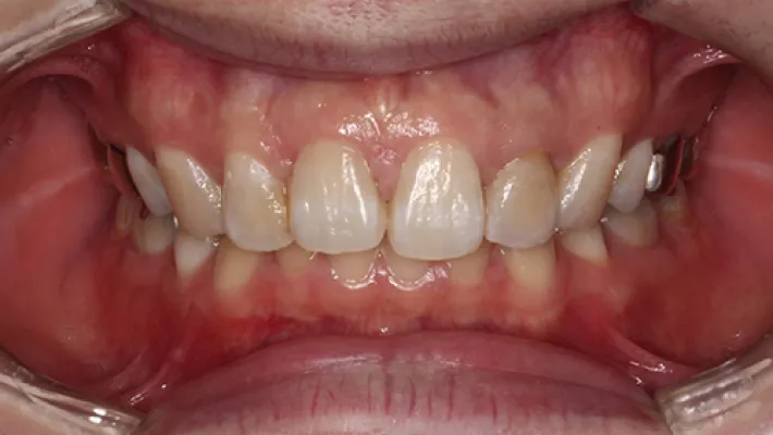 前歯セラミック矯正施術後