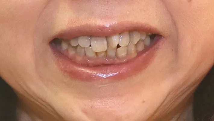 前歯ラミネートベニア修正施術前