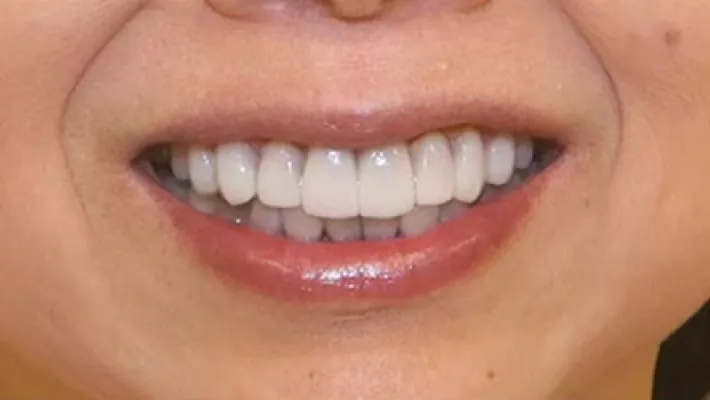 前歯ラミネートベニア修正施術後