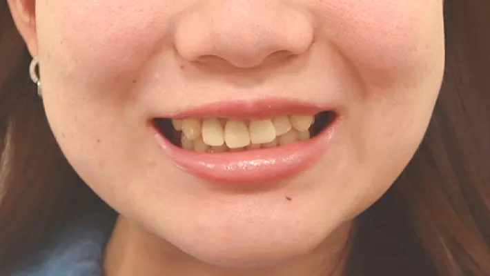 前歯セラミック矯正施術前