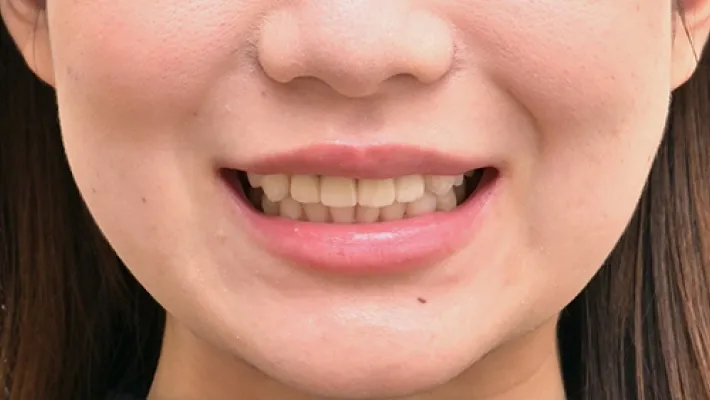 前歯セラミック矯正施術後