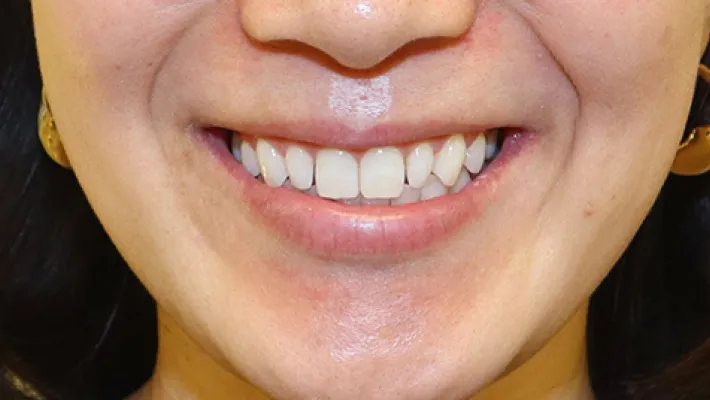 前歯セラミック矯正施術前