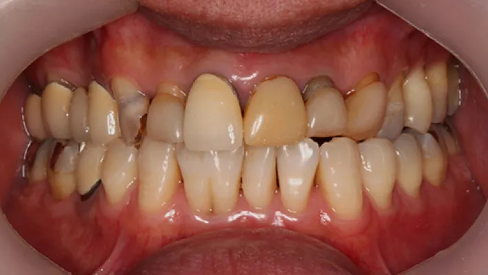 前歯セラミック矯正施術前